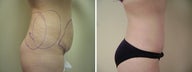 Tummy Tuck