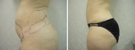 Tummy tuck