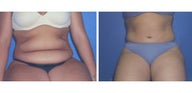 Tummy Tuck