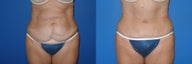 Tummy Tuck