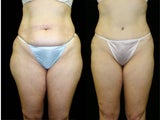 tummy tuck