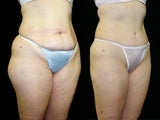 tummy tuck