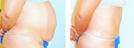 Tummy Tuck