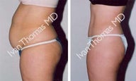 Tummy Tuck