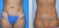Tummy Tuck (Abdominoplasty)