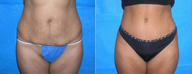 Tummy Tuck (Abdominoplasty)