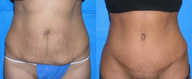 Tummy Tuck (Abdominoplasty)