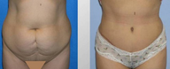 Tummy Tuck (Abdominoplasty)
