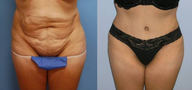 Tummy Tuck (Abdominoplasty)