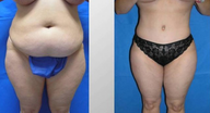 Tummy Tuck (Abdominoplasty)