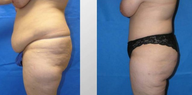 Tummy Tuck (Abdominoplasty)