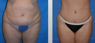 Tummy Tuck (Abdominoplasty)
