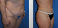 Tummy Tuck (Abdominoplasty)