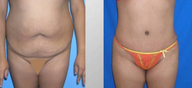 Tummy Tuck (Abdominoplasty)