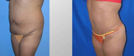 Tummy Tuck (Abdominoplasty)