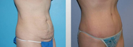 Tummy Tuck (Abdominoplasty)