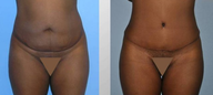 Tummy Tuck (Abdominoplasty)