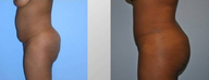 Tummy Tuck (Abdominoplasty)