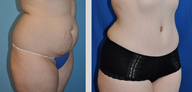 Tummy Tuck (Abdominoplasty)