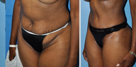 Tummy Tuck (Abdominoplasty)