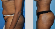 Tummy Tuck (Abdominoplasty)