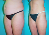 Tummy Tuck