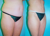 Tummy Tuck