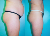 Tummy Tuck