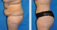 Tummy Tuck