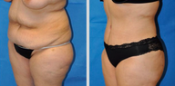 Tummy Tuck