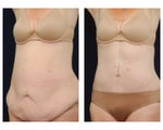 Tummy Tuck or Abdominoplasty
