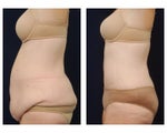 Tummy Tuck or Abdominoplasty