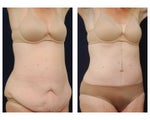 Tummy Tuck or Abdominoplasty
