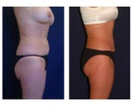 Tummy Tuck or Abdominoplasty
