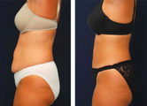 Tummy Tuck / Abdominoplasty  