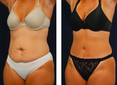 Tummy Tuck / Abdominoplasty  