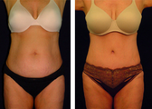Tummy Tuck / Abdominoplasty  