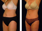 Tummy Tuck / Abdominoplasty  