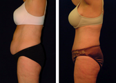 Tummy Tuck / Abdominoplasty  