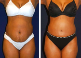 Tummy Tuck / Abdominoplasty  
