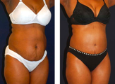Tummy Tuck / Abdominoplasty  