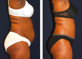 Tummy Tuck / Abdominoplasty  
