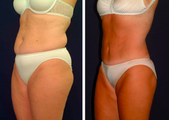 Tummy Tuck / Abdominoplasty  