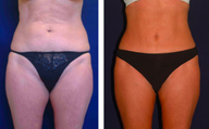 Tummy Tuck / Abdominoplasty  
