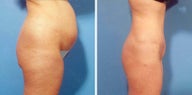 Abdominoplasty