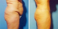 Abdominoplasty