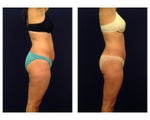 Tummy Tuck / Abdominoplasty