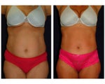 Tummy Tuck / Abdominoplasty