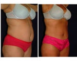 Tummy Tuck / Abdominoplasty