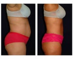 Tummy Tuck / Abdominoplasty